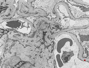 M,65y. | difuse diabetic glomerulosclerosis